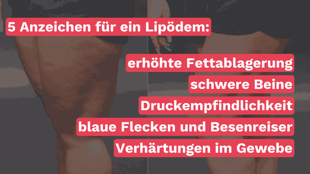 Grafik mit dem Titel "5 Anzeichen für ein Lipödem", die die häufigsten Symptome darstellt. Gezeigt werden erhöhte Fettablagerungen, schwere Beine, Druckempfindlichkeit, blaue Flecken und Besenreiser sowie Verhärtungen im Gewebe. Die Grafik illustriert visuell die typischen Merkmale eines Lipödems, um die Erkrankung leichter erkennen zu können.