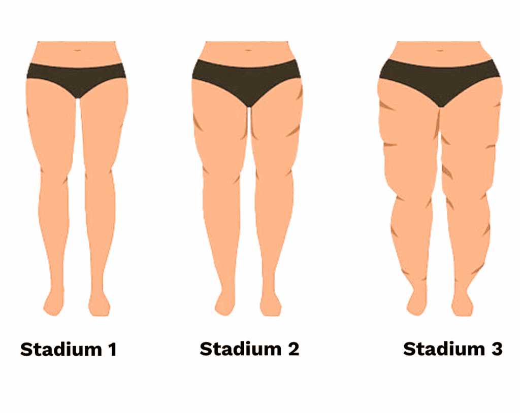 Grafik von drei Stadien des Lipödems bei Frauen. Links zeigt das Bild das Lipödem im Stadium 1 mit leichten Fettansammlungen an den Beinen, in der Mitte das Lipödem im Stadium 2 mit verstärkter Fetteinlagerung und deutlicherer Kontur an Oberschenkeln und Knien, und rechts das Lipödem im Stadium 3 mit stark ausgeprägten Fettpolstern und Verformungen.