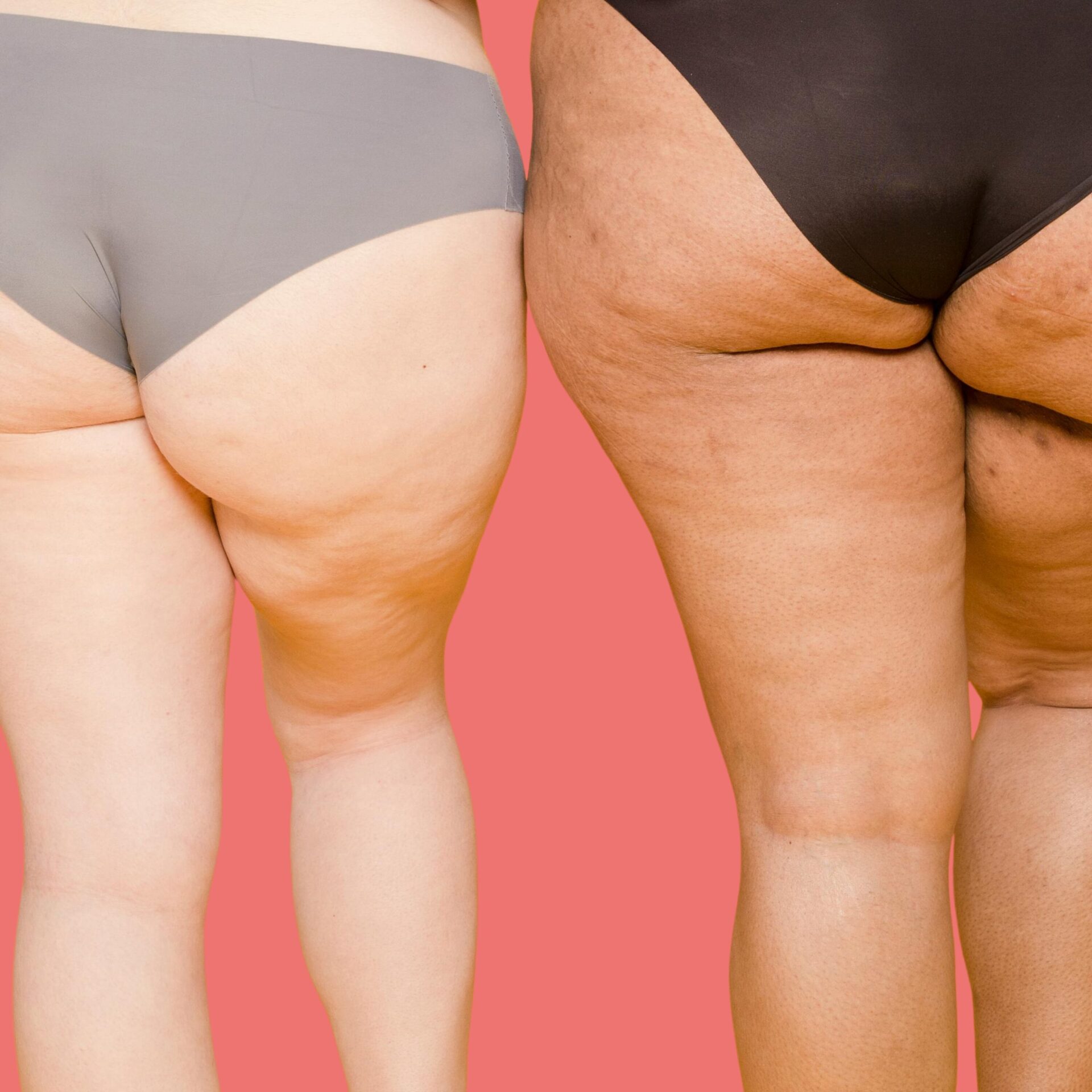 Beine von zwei Frauen mit Cellulite Haut durch Lipödem