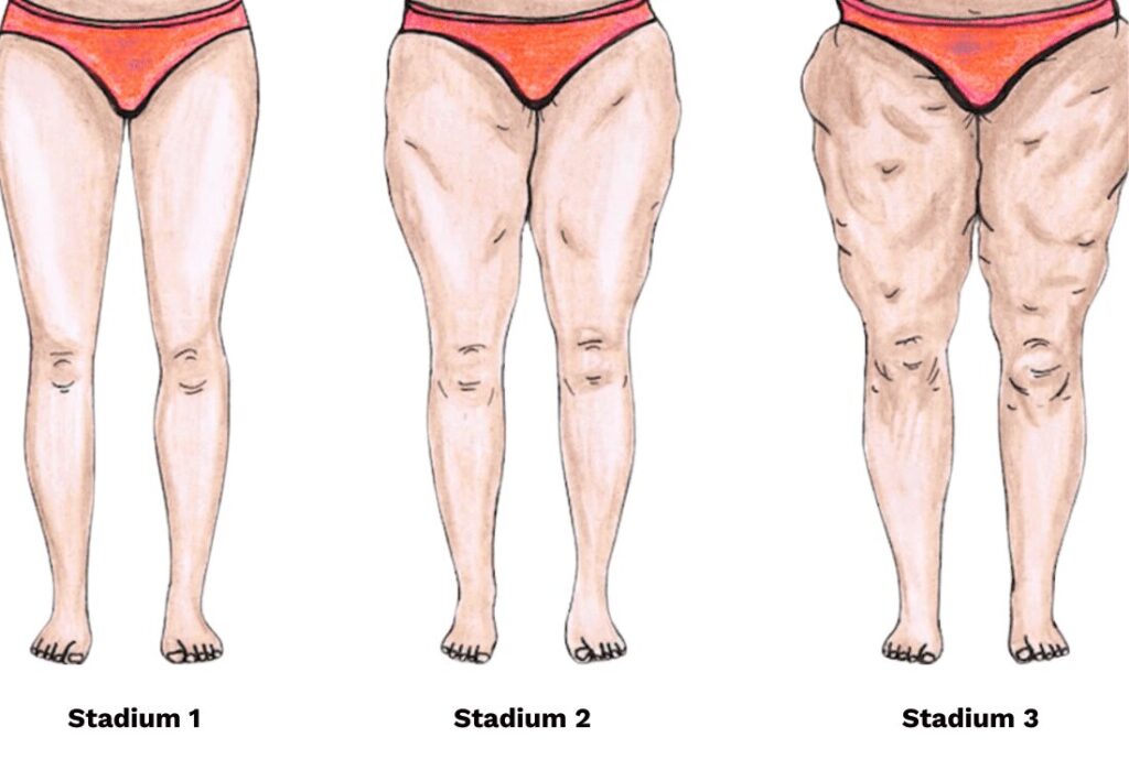 Illustration von drei Stadien des Lipödems bei Frauen. Links zeigt das Bild das Lipödem im Stadium 1 mit leichten Fettansammlungen an den Beinen, in der Mitte das Lipödem im Stadium 2 mit verstärkter Fetteinlagerung und deutlicherer Kontur an Oberschenkeln und Knien, und rechts das Lipödem im Stadium 3 mit stark ausgeprägten Fettpolstern und Verformungen. Die Grafik visualisiert die fortschreitenden Veränderungen im Erscheinungsbild der Beine durch das Lipödem, insbesondere im Stadium 2, in dem die Fettansammlungen zunehmend auffallen.