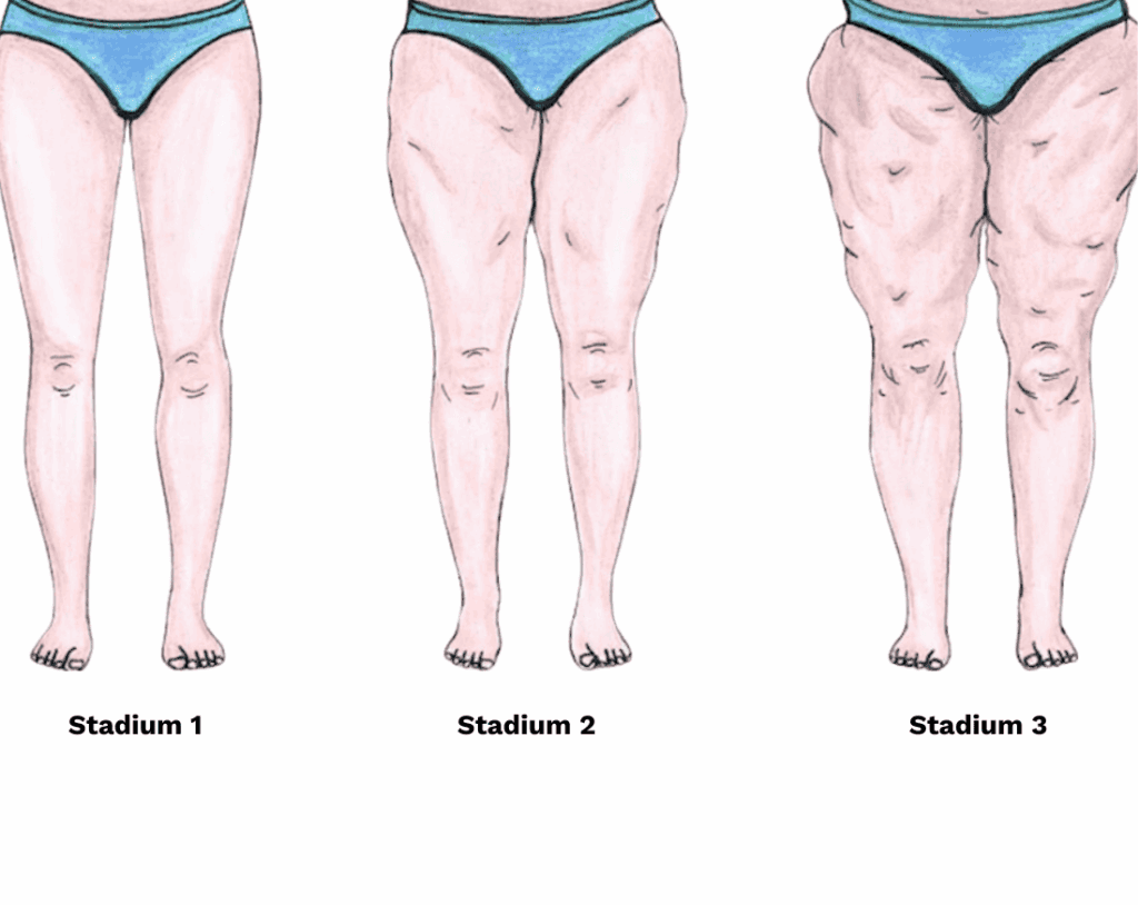 Grafische Darstellung der drei Stadien des Lipödems mit wachsender Gewebeveränderung und Umfangszunahme der Beine.